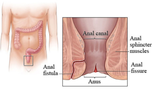 Fistula Anal Surgery