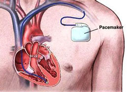 Permanent Pacemaker Implantation