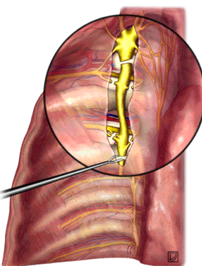Endoscopic Thoracic Sympathectomy (ETS)