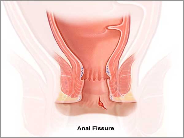 Fissurectomy