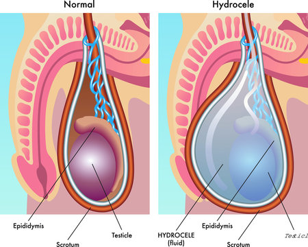 Hydrocele repair