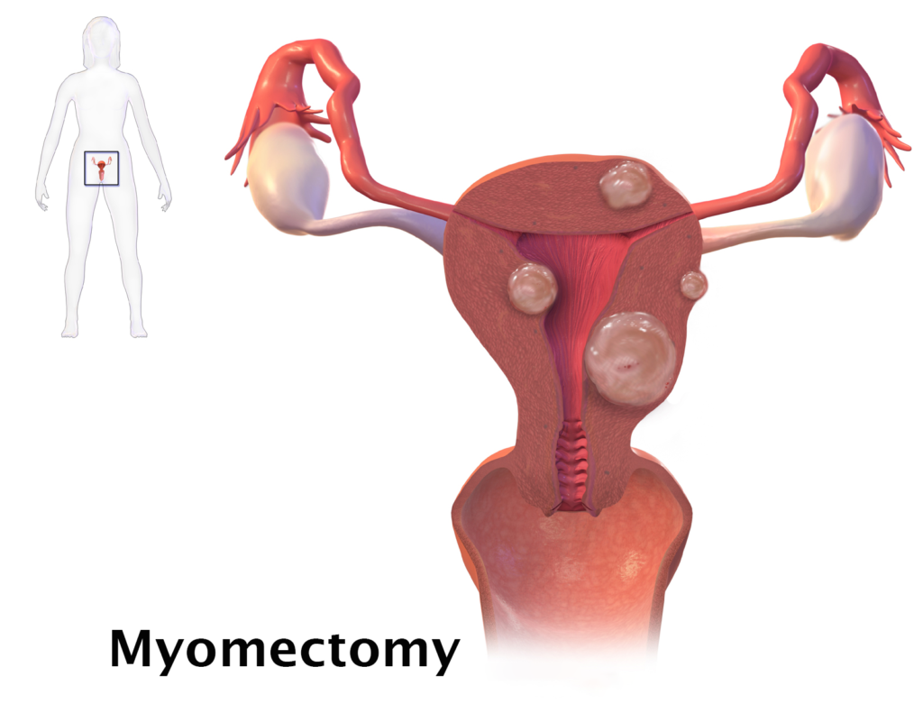 Laparoscopic Myomectomy
