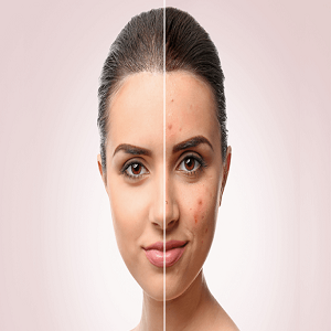 How is acne treated?