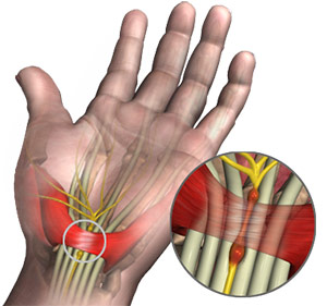 Surgery for Carpal Tunnel Syndrome (CTS)
