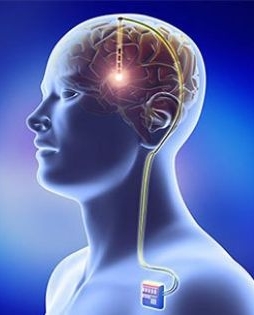 Deep Brain Stimulation (DBS) Surgery for Parkinson’s Disease