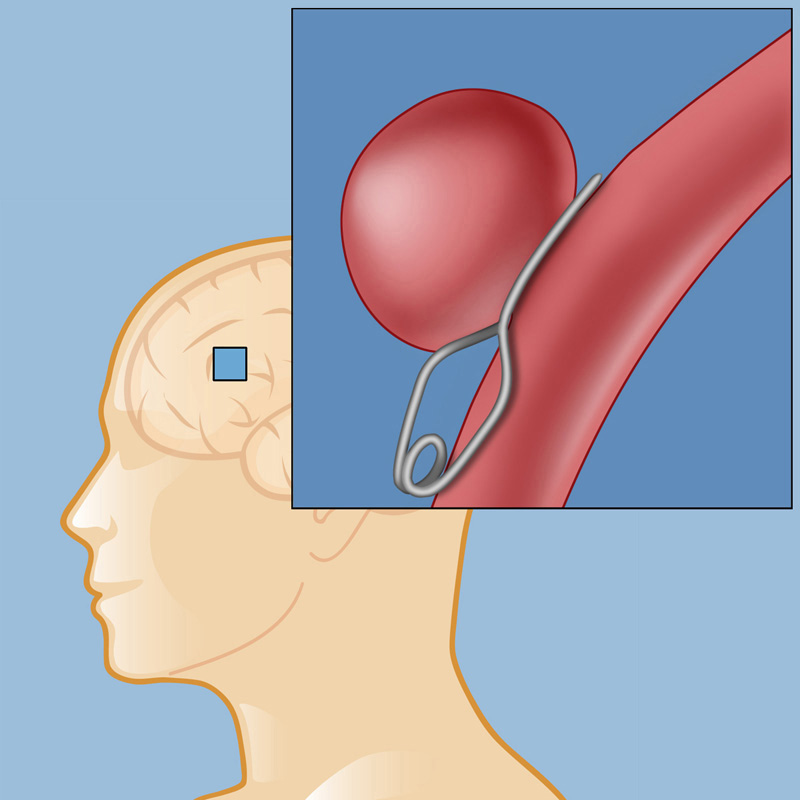 Brain Aneurysm Surgery