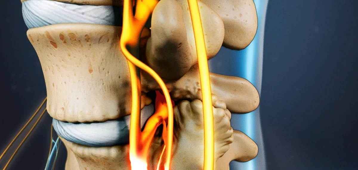 Lumbar Spinal Canal Stenosis