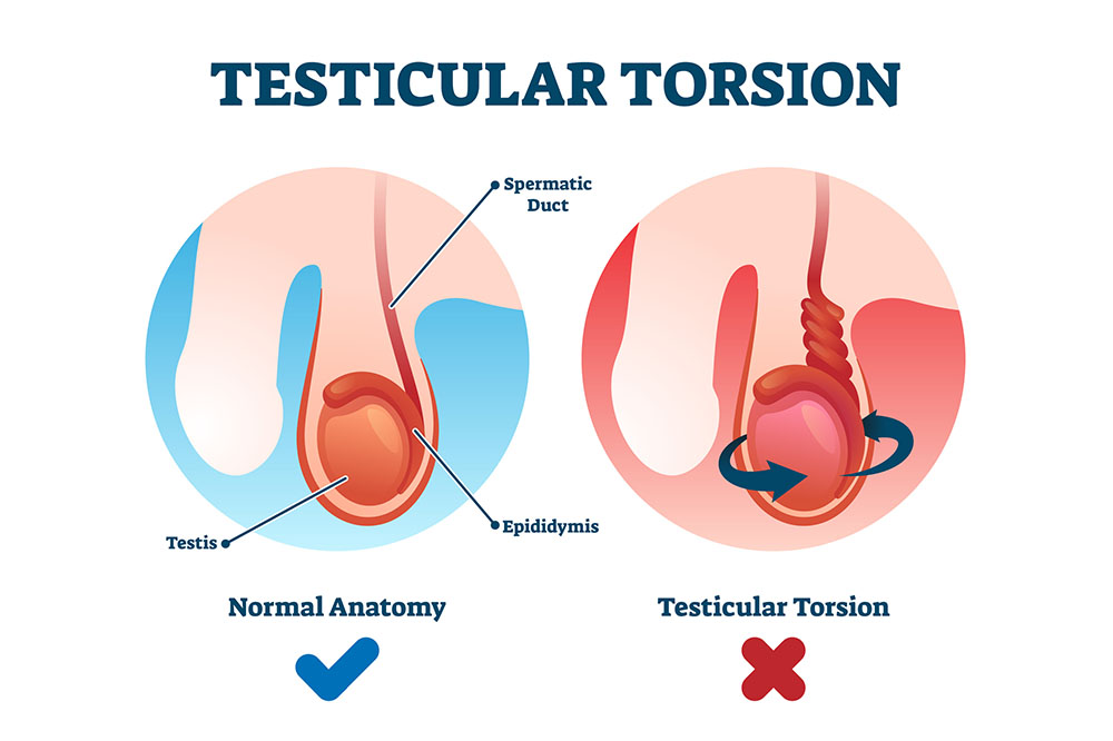 Testicular Torsion Surgery